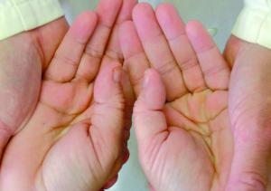  Die Hände des Patienten in der Hand des Testers beim neutralen Ausgangsbefund