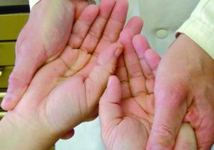 Die Hände des Patienten in der Hand des Testers beim positiven Armlängenreflex